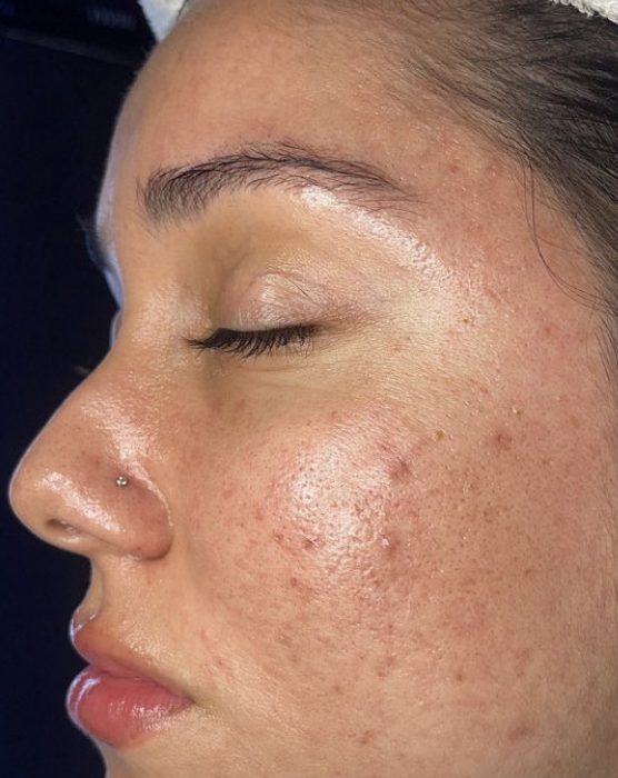  IMG_6062-1-556x700 Hydra Facial  