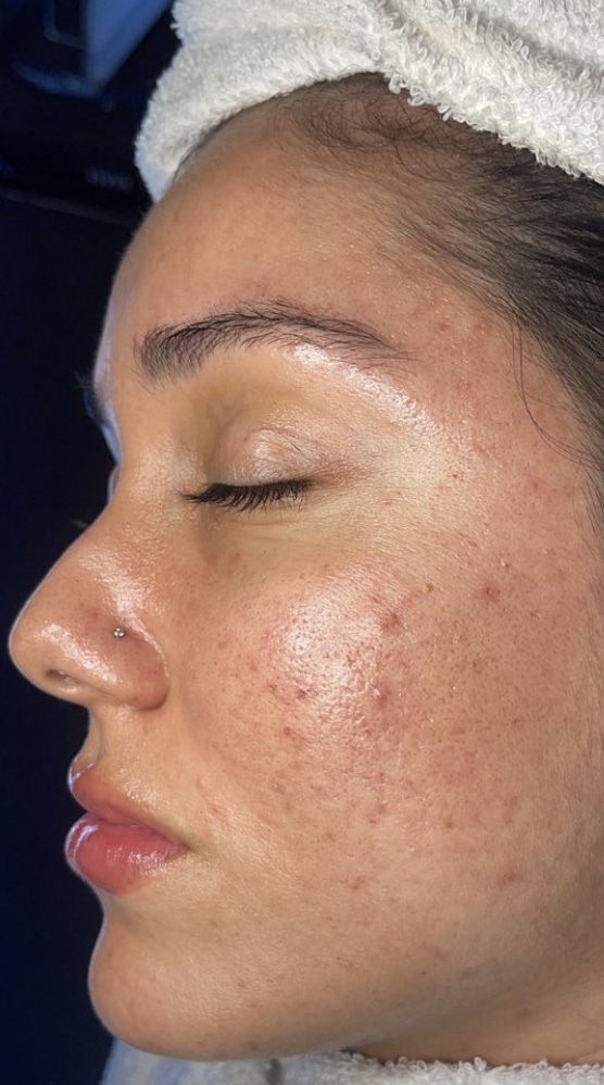 IMG_6062-1 Hydra 4 Facial