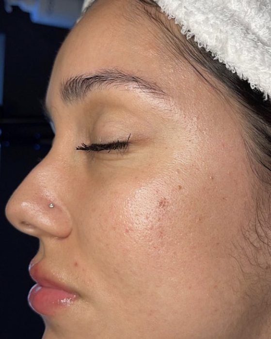  IMG_6062-2-559x700 Hydra Facial  