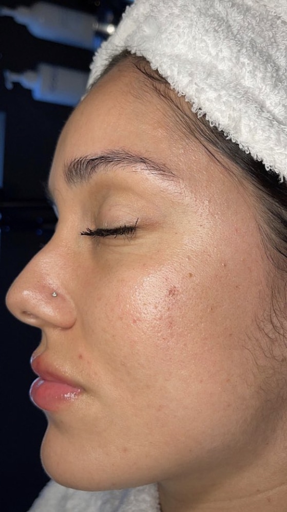 IMG_6062-2 Hydra 4 Facial