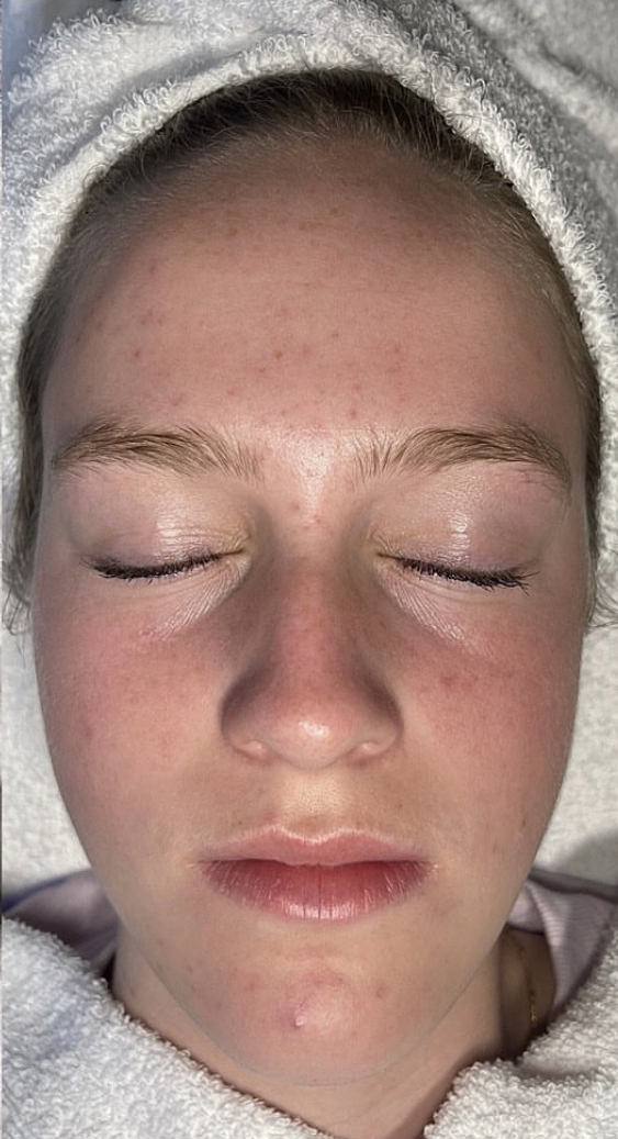 IMG_6063-1 Hydra 4 Facial