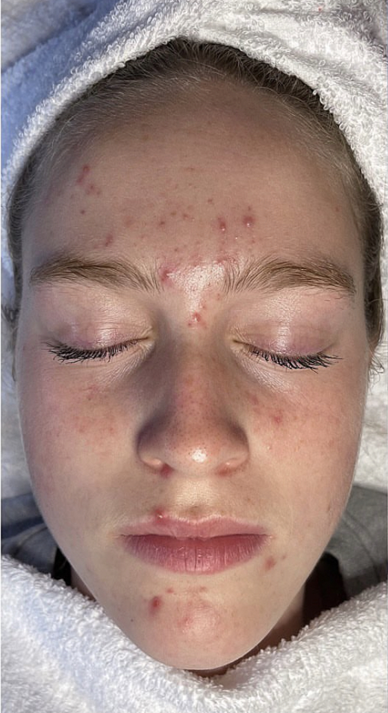 IMG_6063-2 Hydra 4 Facial