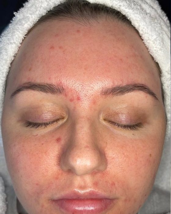  IMG_6064-10-560x700 Hydra Facial  