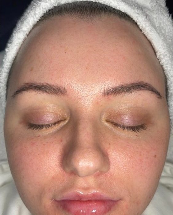  IMG_6064-11-563x700 Hydra Facial  