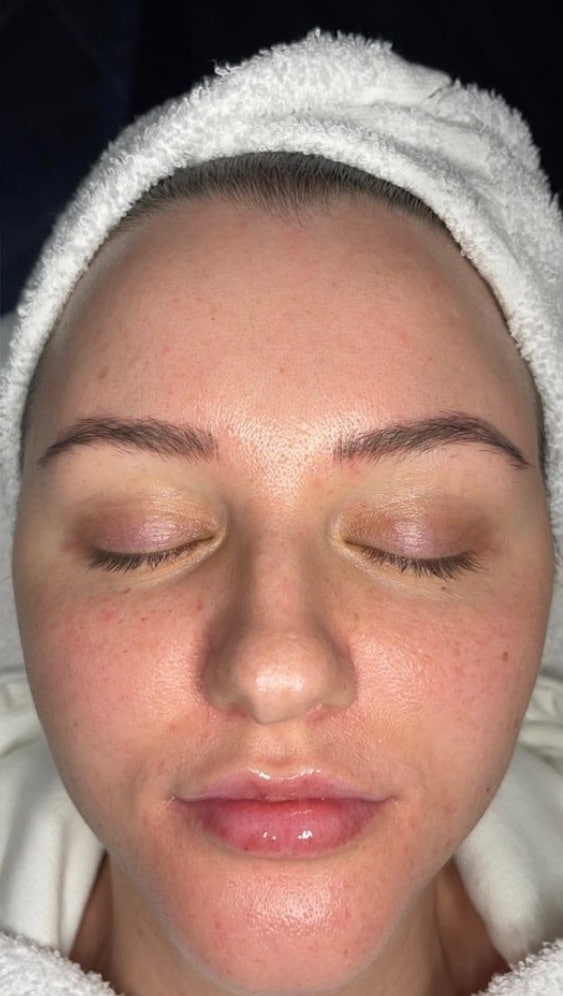  IMG_6064-11 Hydra 4 Facial  